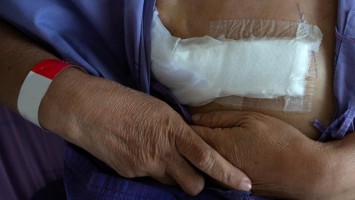 Frau hält sich eine Brustseite nach Mastektomie