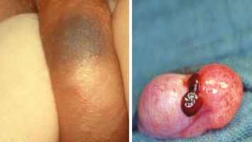 Hydatidentorsion und intraoperativer Befund einer stielgedrehten Hydatide.