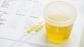 Urinbecher und Urinanalyse-Streifen