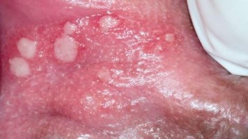 41-jährige Patientin mit Läsionen eines Herpes genitalis an der Vulva