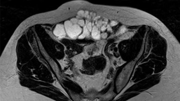 CT bei endometrioidem Karzinom
