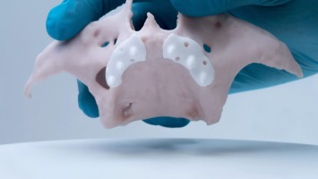 First 3D-Printed Ceramic Jaw Implant Placed in Patient