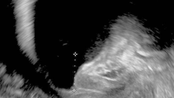 rotatorischer Descensus urethrae mit einem Meatus urethrae internus