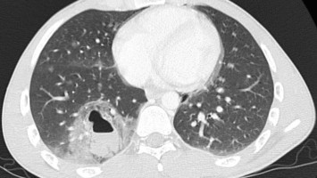 Thorax-Computertomographie des 23-Jährigen