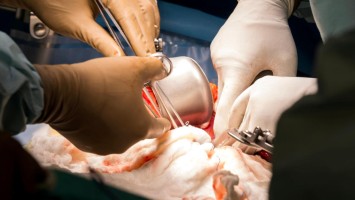 Ein chirurgisches Team führt eine abdominelle Operation durch