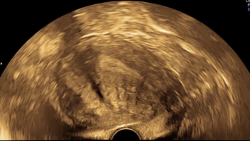 Asymmetrische Adenomyose der uterinen Vorderwand