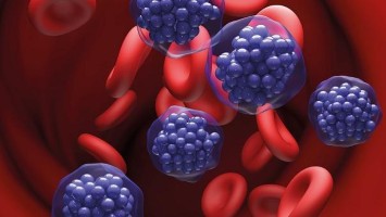 Teaserbild: Diffuses großzelliges B-Zell-Lymphom