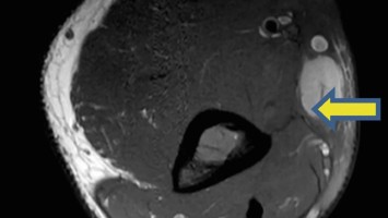 Weichteiltumor