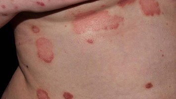 Psoriasis "flare up" in der Schwangerschaft
