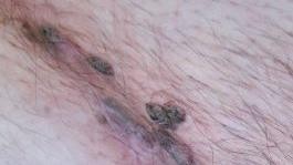  Condylomata acuminata an Mons pubis und Leiste