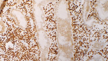 Endometriumbiopsat vom 19. Zyklustag