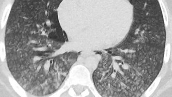 Akutes Atemnotsyndrom (ARDS)