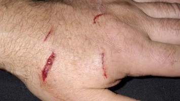 Hand mit Hundebiss