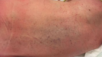 Thrombozytenfunktionsstörung