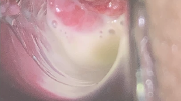 Trichomonas vaginalis Infektion