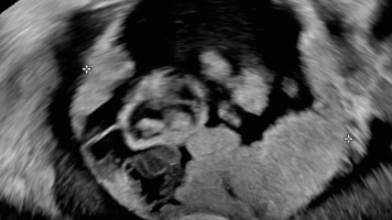 Irregulärer multilokulär-solider Adnextumor