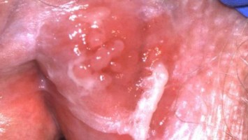 Lichen sclerosus und vulväre intraepitheliale Neoplasie
