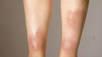 Erythema nodosum
