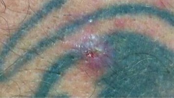 Hautkrebs im Tattoo