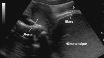 Kindergynäkologischer Ultraschall