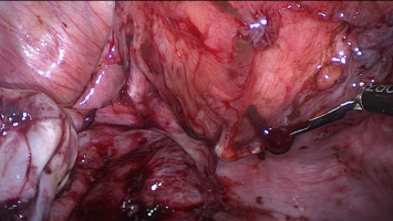 Endometriose und Adenomyose am Uterus