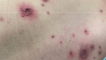 Disseminiertes Pyoderma gangraenosum bei Colitis ulcerosa