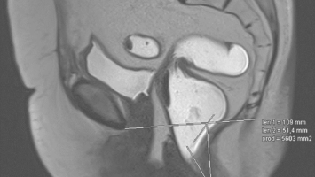 Magnetresonanz-Defäkographie des Rektums