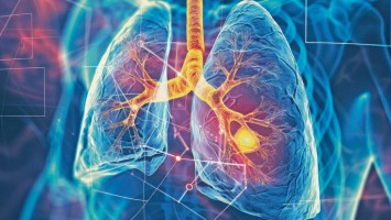 Lungenkarzinom