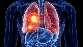 Zielgerichtete Therapie bei NSCLC