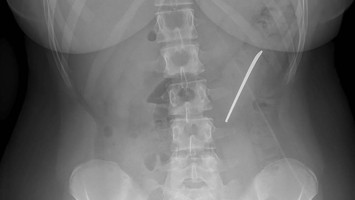 Röntgen des Abdomens, worauf ein verschluckter Löffelstiel zu sehen ist