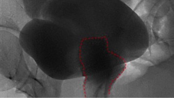 Urogenitale Fistel bei einer 36-jährigen Patientin