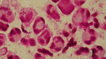 Histologie von Gonokokken