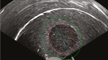 Intrauteriner Ultraschallbild mit Myom