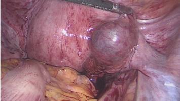 Tubargravidität rechts