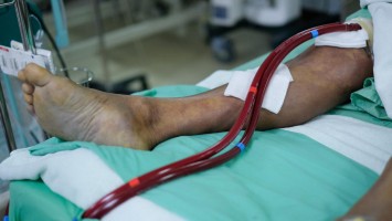 Patient an der ECMO: blutführende Schläuche
