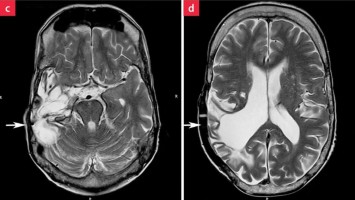 Normaler Verlauf nach Hirntumor?