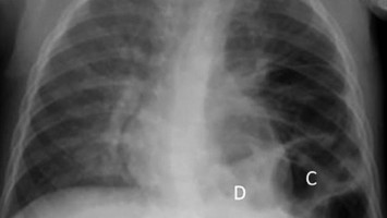 Angeborene Zwerchfellhernie