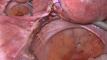 Aufnahme nach Resektion der Extrauteringravidität