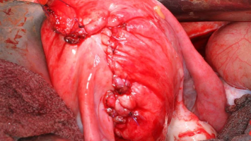 Endsitus nach Uterusrekonstruktion