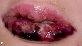 Blutige Mukositis Tag 9 nach stationärer Aufnahme