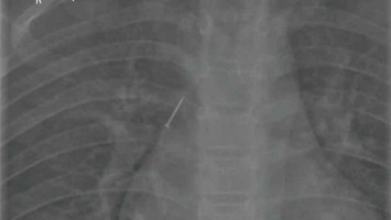 12-Jähriger aspiriert Pinnnadel