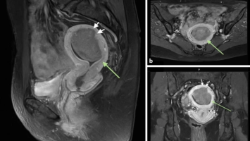 MRT einer intrakavitären Raumforderung