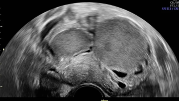 Ultraschall der "kissing ovaries" bei Endometriose