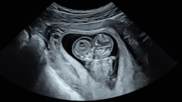 Feten von siamesischen Zwillingen