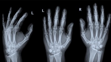 Röntgenbild Hand