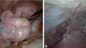 Entzündeter Uterus in der Laparoskopie