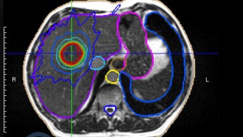 Körperstereotaxie einer Lebermetastase im Segment VIII am MR-LINAC