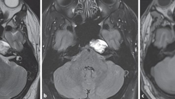 Cholesterolgranulom im MRT
