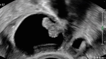 Ultraschall eines Adnextumors