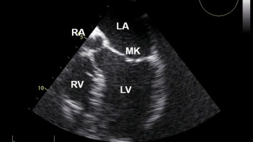 Transösophageale Echokardiographie (fTEE), 4‑Kammer-Blick